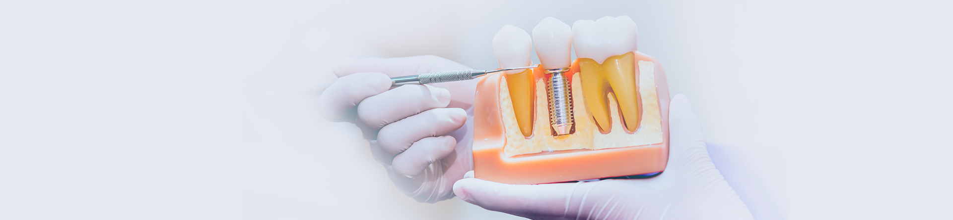 Emergency Dental Crown Repair