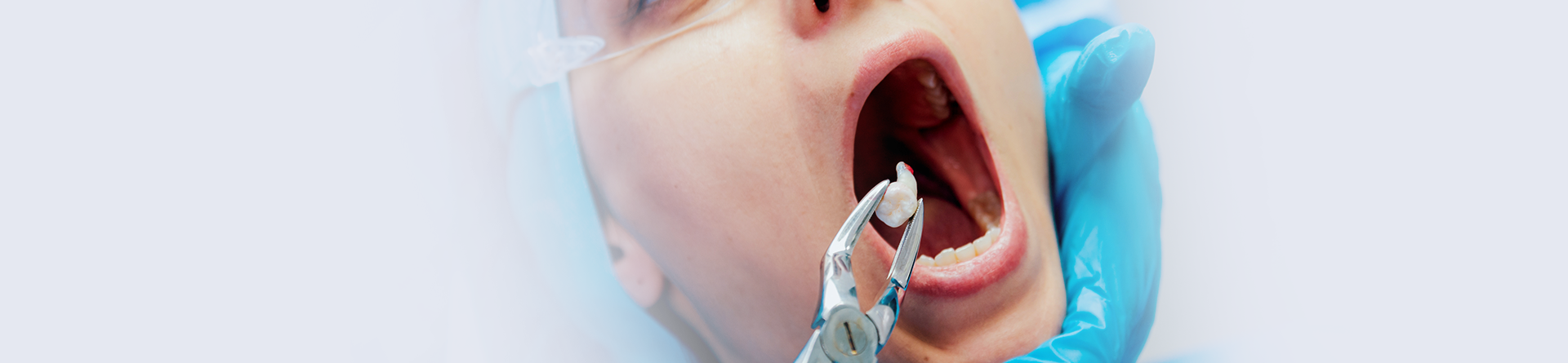 Wisdom Tooth Removal Chelsea, London